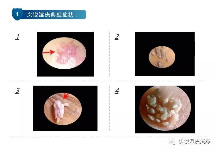 尖锐湿疣,“近期热议的性病之一：典型性病症状——尖锐湿疣。”