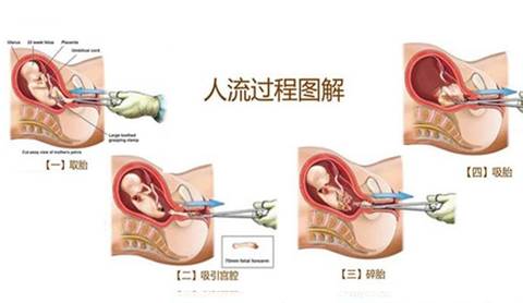 最新人流技术是什么,“前沿人流技术揭秘，最新动态抢先看”