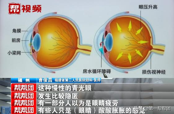 青光眼的最新消息,聚焦青光眼研究进展，最新突破引关注